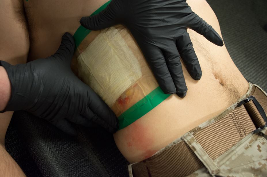 A seal being placed on someone’s wound