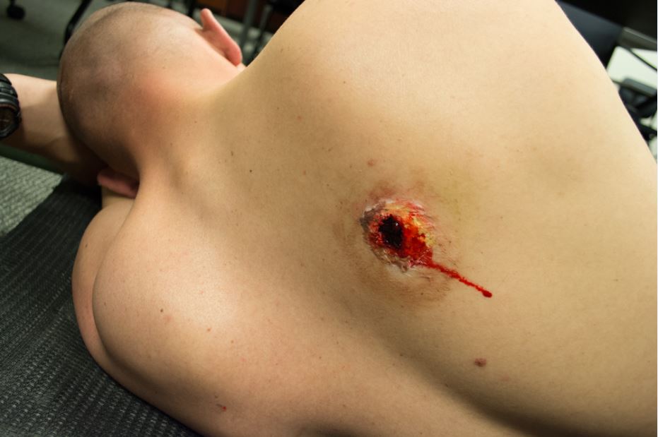 A woman with an eye injury on her chest.