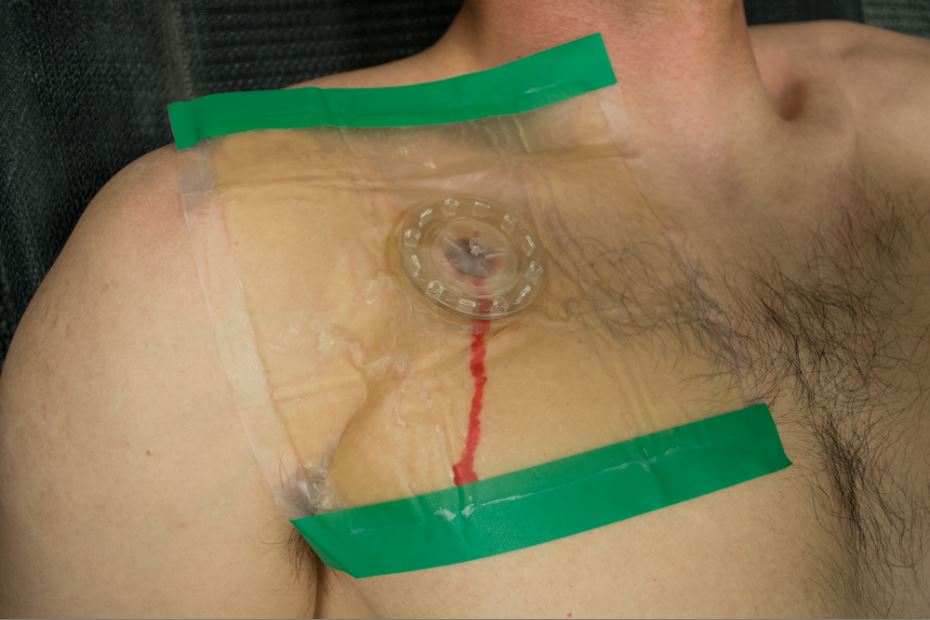 Our wound seal covering the wound of a man