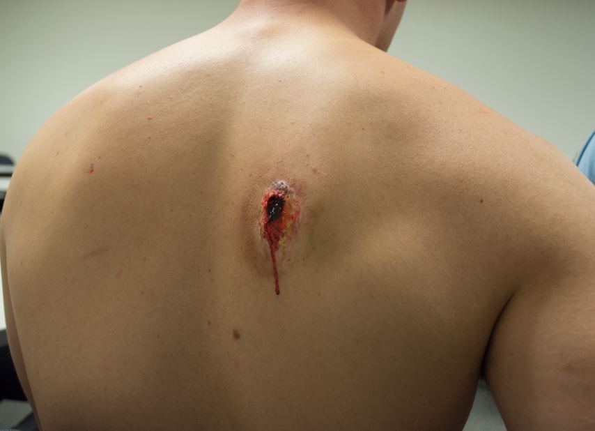 A large circular wound on a man’s back